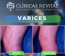 Tratamiento varices - Clínicas Revitae