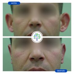 Otoplastia - Clínicas Revitae