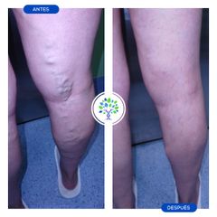 Tratamiento varices - Clínicas Revitae