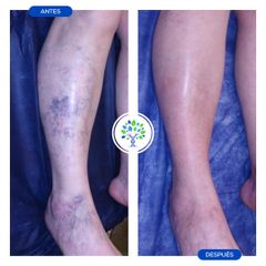 Tratamiento varices - Clínicas Revitae
