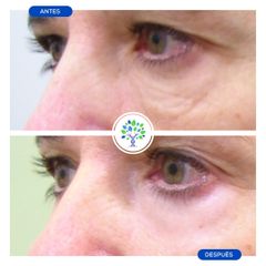Blefaroplastia - Clínicas Revitae