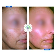 Rellenos faciales - Clínicas Revitae