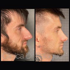 Rinoplastia - Clinica Dr Balaguer