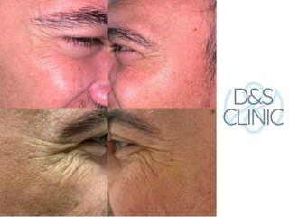 Bótox - D&S Clinic
