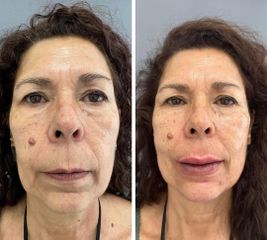 Aumento de labios - Clínicas CAME Murcia