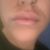 Aumento de labios 3 viales labio muy fino
