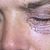 Blefaroplastia en párpados superiores e inferiores con Plasmage.. 100% recomendable!!