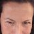 Mi blefaroplastia me ha quitado 10 años de encima!
