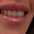 Aumento de labios con grasa