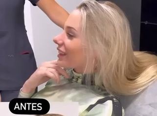 Rinoplastia - Clínicas Aura