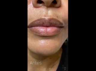 Aumento de labios - Clínica Graziella Moraes