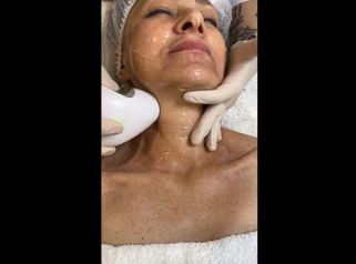 Radiofrecuencia facial - Marista Clínica