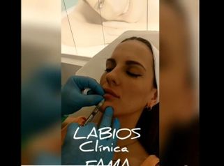 Aumento de labios - Clínica Fama
