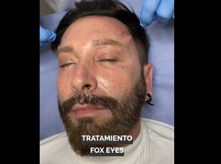 Hilos tensores faciales - Ilahy Instituto Dermoestético