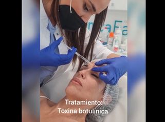 Toxina botulínica - Clínica Fama