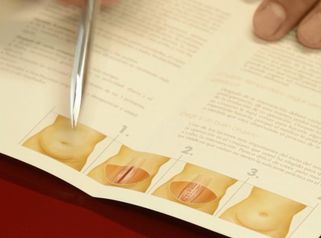 Abdominoplastia o cirugía estética del abdomen