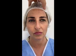 Blefaroplastia - Marista Clínica