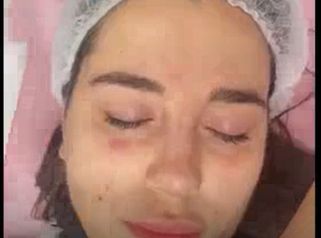 DERMAPEN