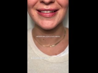 Aumento labios - Clinica Doctor Morano